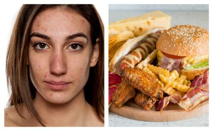 Lo que tienes que saber de la comida y el acné