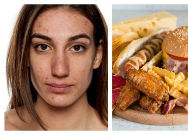 Lo que tienes que saber de la comida y el acné