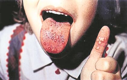 ​Alerta por coxsackie, lo más compartido