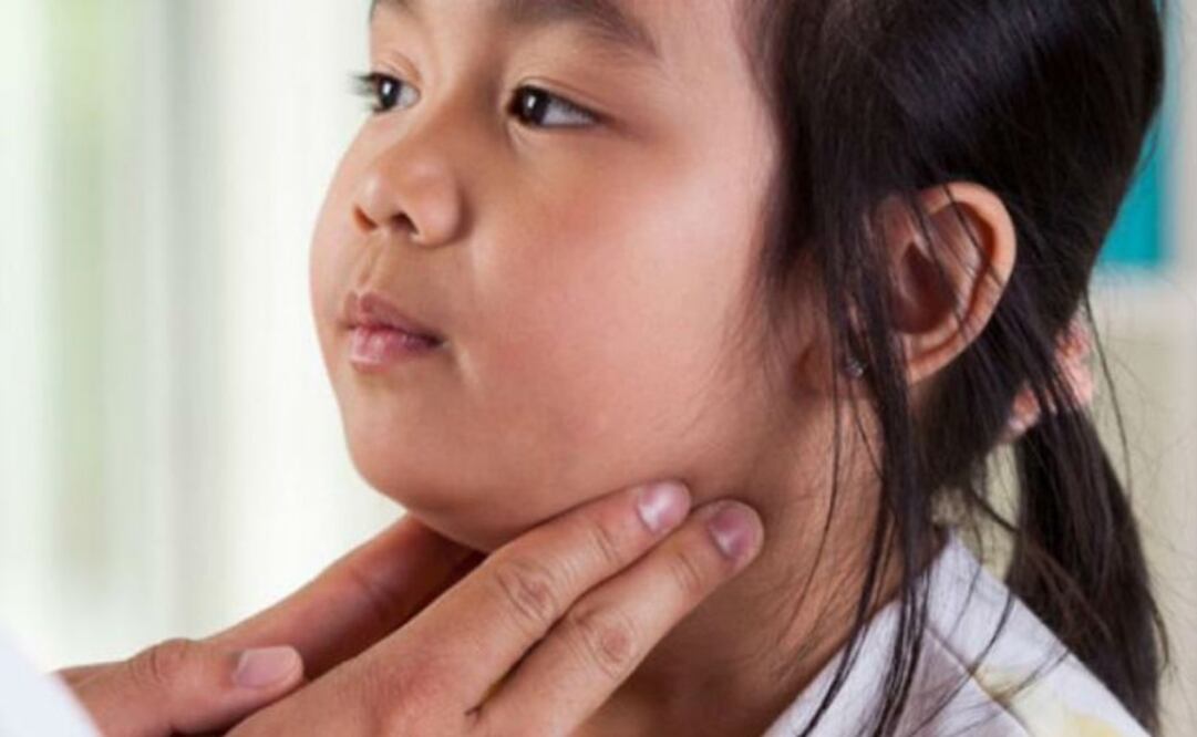  Las paperas son causadas por el virus RNA monocatenario. (FOTO: Especial)