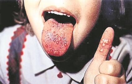 Alerta de virus de coxsackie, en siete entidades del país