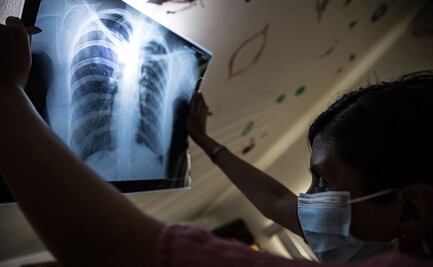 Mujer se fractura cuatro costillas tras un ataque de tos