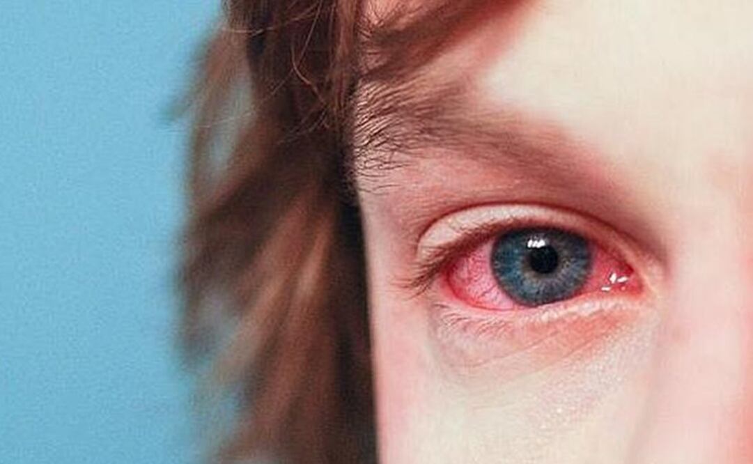 Casos de conjuntivitis disminuyen un 13% en Mérida
