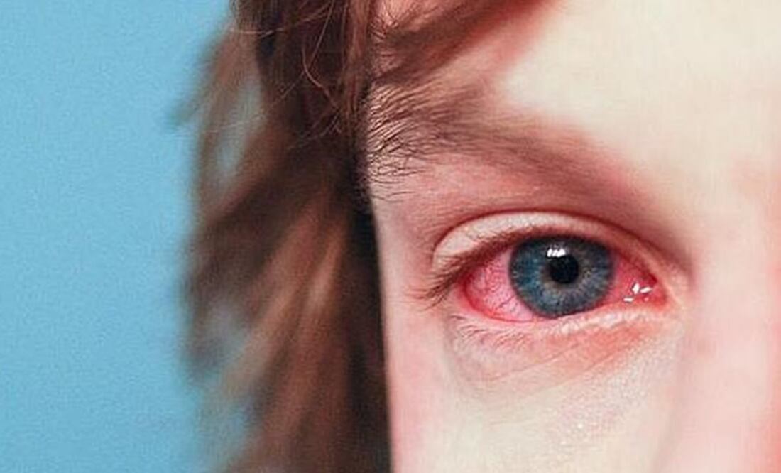 Casos de conjuntivitis disminuyen un 13% en Mérida