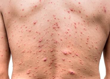 Salud reporta 49 casos confirmados de viruela del mono en México