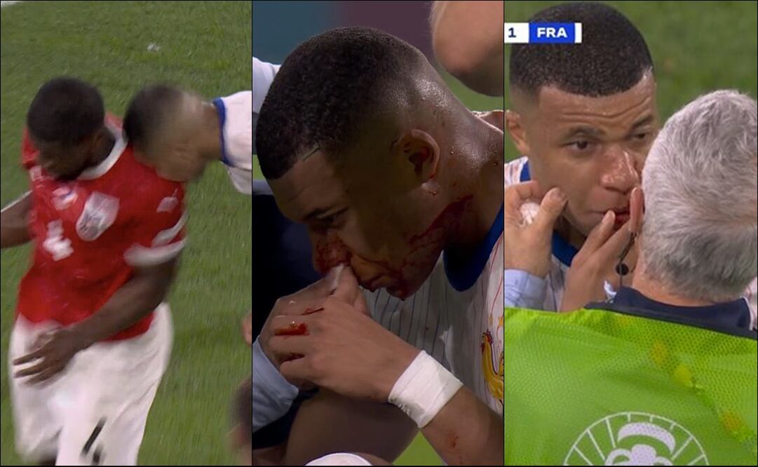 Kylian Mbappé se llevó un durísimo golpe en la nariz - Fotos: Capturas de pantalla