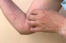 Detectan tres casos importados de sarampión en Morelos; la familia portadora residió en Michoacán en los últimos meses