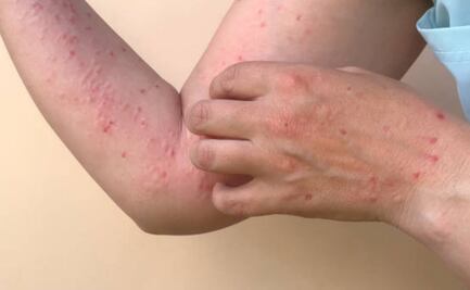 México confirma 78 nuevos casos de sarampión en una semana; Chihuahua, Jalisco y Michoacán tienen la mayoría