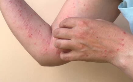 Confirman primer caso de sarampión en Sonora; se trata de una mujer que viajó a Chihuahua