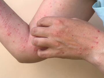 Detectan tres casos importados de sarampión en Morelos; la familia portadora residió en Michoacán en los últimos meses