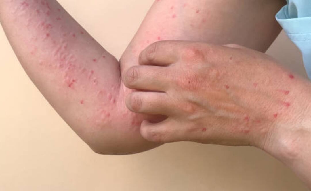 Las niñas y niños de 1 a 4 años siguen siendo el grupo más afectado por el virus. Foto: iStock