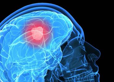 Uno de los tumores más letales, provocado por efectos de las hormonas sexuales