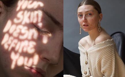 Free the pimple, un movimiento lleno de amor propio y cutis felices