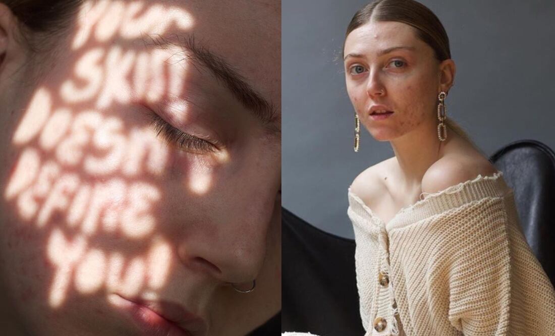 Este nuevo movimiento nos invita a amar nuestra piel Foto: instagram @freethepimple_