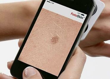 Aplicaciones móviles permitirán detección de cáncer de piel