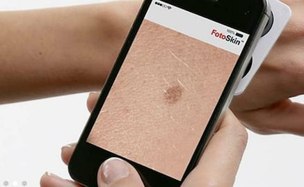 Aplicaciones móviles permitirán detección de cáncer de piel
