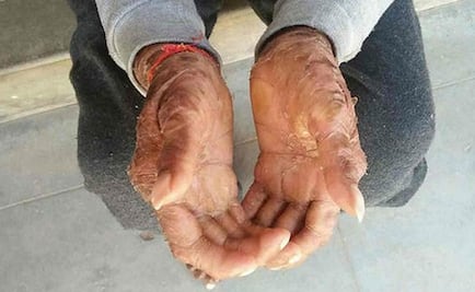 Adolescente india cambia de piel cada 45 días