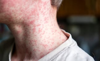 Sarampión en Chiapas: ¿cuáles son los síntomas, cómo se contagia y qué hacer para prevenirlo?