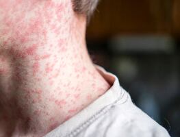 ¿Cuáles son los síntomas del sarampión? Brote que mantiene en alerta a México