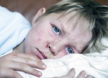 "Amnesia inmunológica", cuando el sarampión resetea la memoria de las enfermedades que padeciste