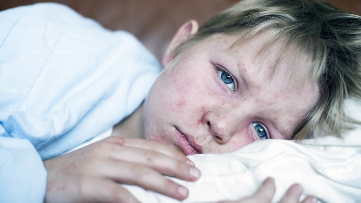 Infante infectado por el sarampión. Foto: BBC