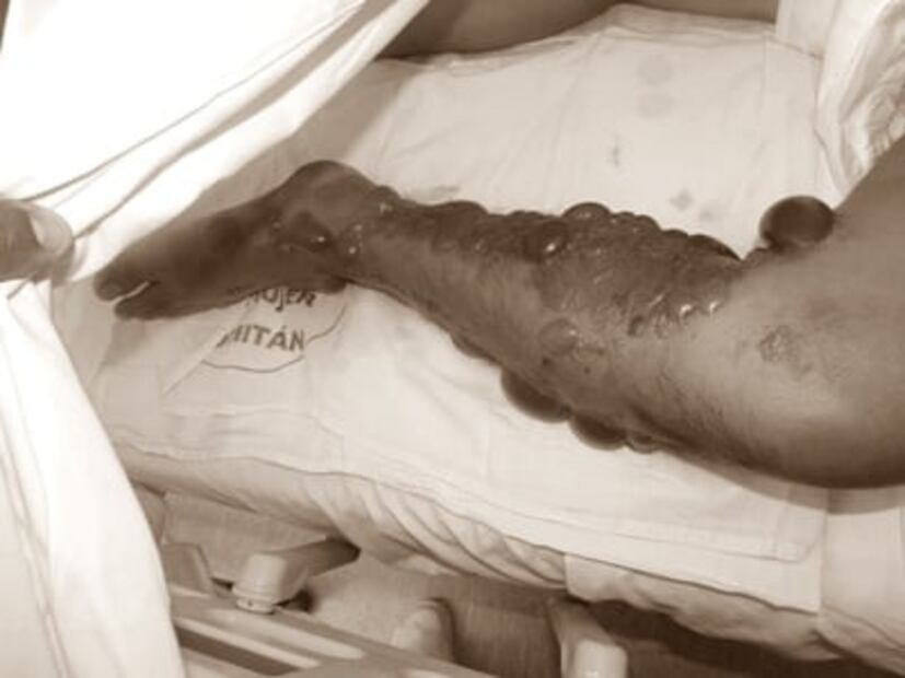 Sobrevive a ataque de serpiente en su parcela