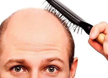 Descubren por casualidad una posible cura a la calvicie