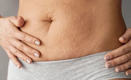 El tratamiento natural que te hará decirle adiós a las estrías