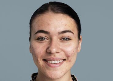 Esta es la relación entre el acné y las hormonas