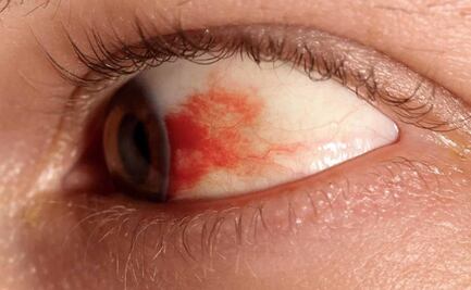 UNAM desarrolla gotas contra la ceguera por diabetes; buscan reemplazar tratamientos con inyecciones intraoculares