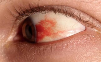 UNAM desarrolla gotas contra la ceguera por diabetes; buscan reemplazar tratamientos con inyecciones intraoculares