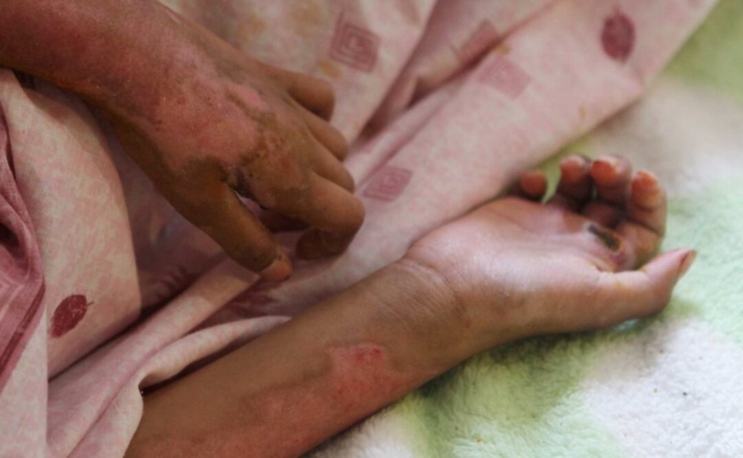 Alrededor de 13 mil personas reportan quemaduras en el país. Foto: ilustrativa. Archivo/EL UNIVERSAL