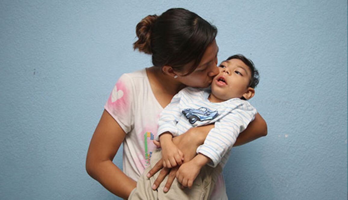 Microcefalia por zika en México