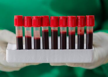 Análisis de sangre preliminar detecta tumores cuatro años antes