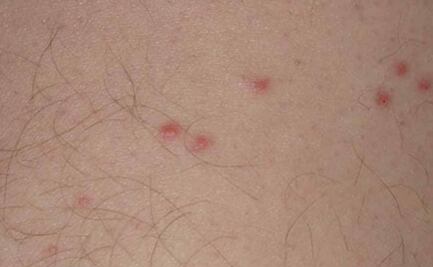 Te decimos qué hacer en caso de picadura de chinches, ¡más vale prevenir!