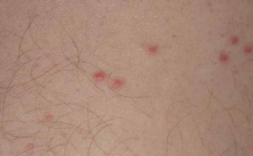 Identificar la picadura de chinches te permitirá tener un mejor tratamiento. / Foto: Especial