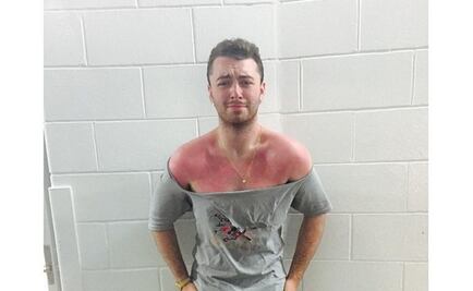 Sam Smith se "quema" y lo muestra en Instagram