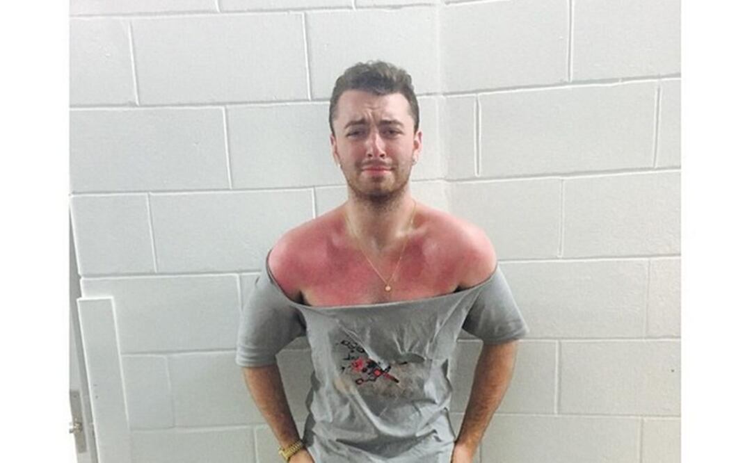 El artista de 23 años subió una foto en la que se aprecian sus sus hombros y parte del torso totalmente enrojecidos . FOTO: Instagram samsmithworld