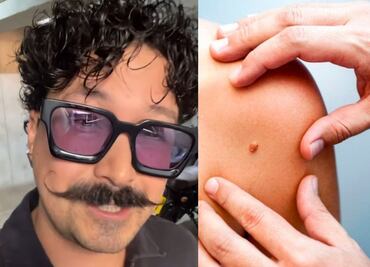 ¿Qué es el cáncer de piel, la enfermedad que padece Mau Nieto?; estos son sus síntomas