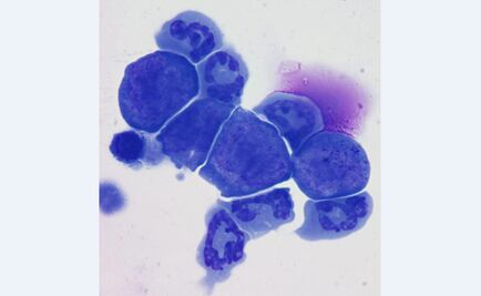 ¿Células cancerosas se comunican a larga distancia?