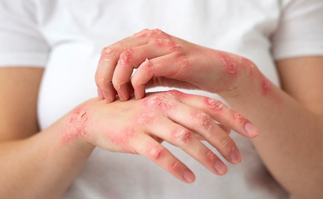 El herpes zóster es una enfermedad benigna, pero que requiere tratamiento. Foto: Freepik