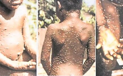 Israel confirma primer caso de viruela del mono