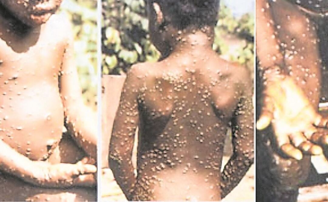 Israel confirma primer caso de viruela del mono