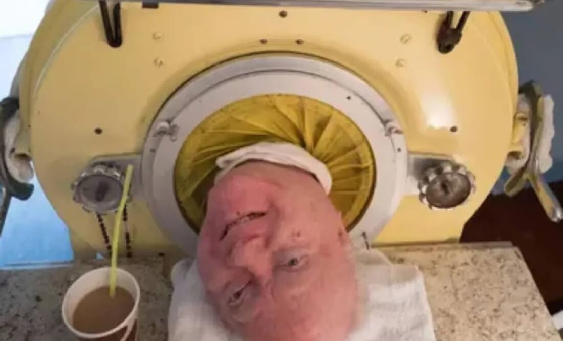 La historia de amor de un hombre que vivió 65 años en un pulmón de acero