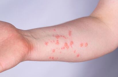 Segundo caso de viruela del mono no enciende alarmas en materia de turismo: autoridades