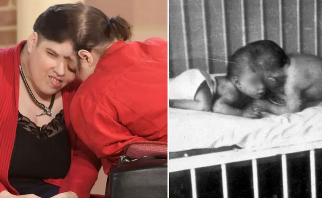 A pesar de estar unidos por la cabeza, los gemelos se diferenciaban en muchos aspectos. Foto: Récord Guinness