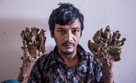 El "hombre-árbol" pide ser amputado