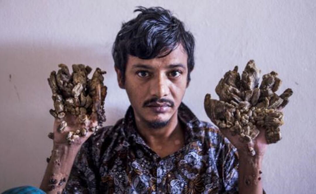 Abul Bajandar, de 28 años, sufre epidermodisplasia verruciforme, una rara enfermedad genética. Foto: AFP