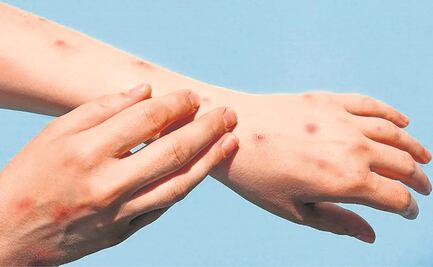 Piden no caer en pánico por viruela del mono