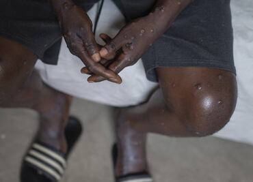 Mpox: ¿es más mortal la variante de la viruela del mono por la que se declaró emergencia internacional?